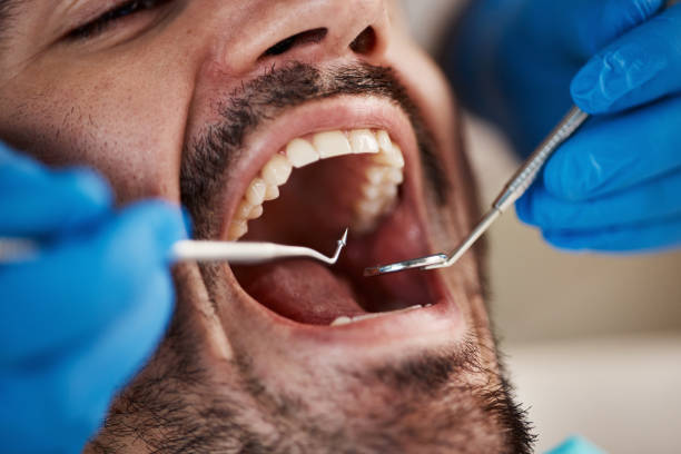 Best Dental Bonding  in Kirkl, IN